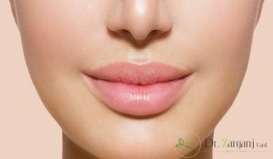 لیست افرادی که برای انجام لیفت لب بالا با نخ مناسب هستند