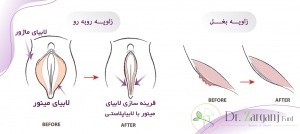 هزینه جراحی عمل لابیا پلاستی