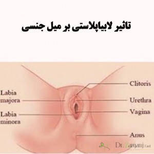 تاثیر عمل لابیاپلاستی بر روی رابطه جنسی