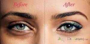 عوارض کربوکسی تراپی دور چشم