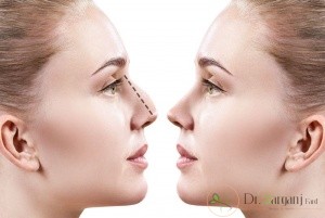 علت گلوله شدن چربی تزریق شده