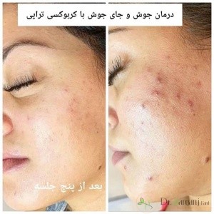 طول درمان کربوکسی تراپی به چه میزان است: