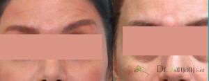 مراقبت های ویژه پس از عمل تزریق چربی چه مواردی را شامل می شود ؟