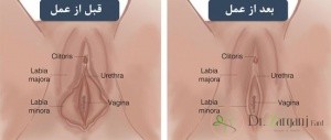 بهترین پزشک لابیاپلاستی