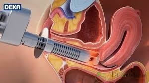 آیا انجام عمل تنگ کردن واژن با لیزر برای فرد متقاضی دردناک است ؟