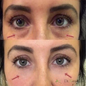 کربوکسی تراپی به چه معناست: