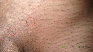 عفونت ناشی از ویروس پاپیلومای انسانی یا ویروس HPV :