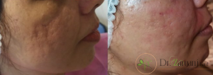 روش انجام زیبایی به طریق تزریق چربی در بدن به چه نحوی انجام می شود ؟