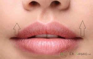 انجام روش لیفت لب بالا با نخ برای کدام دسته از افراد مناسب است ؟