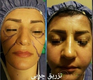 مزیت تزریق چربی