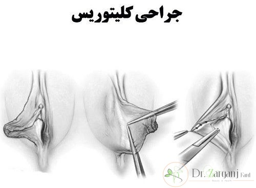 جراحی زیبایی کلیتوریس به چه طریق انجام می شود؟