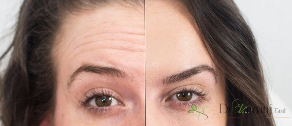 مشاوره اولیه برای انجام عمل بوتاکس توسط بهترین متخصص بوتاکس به چه صورت است؟