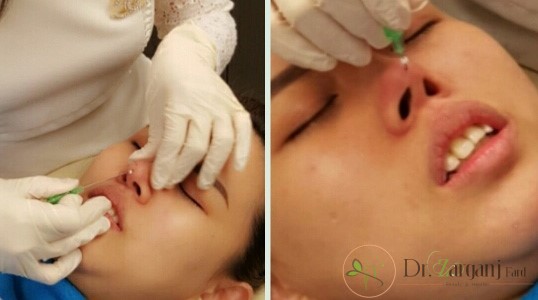 آیا روش غیر جراحی عوارض جانبی هم دارد ؟