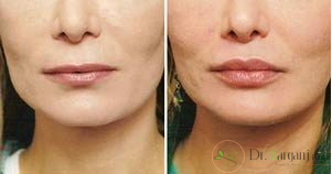 سوالات رایج درباره جراحی لب