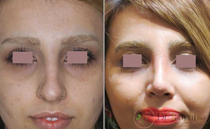 اصلاح بینی به روش لیفتینگ یا غیر جراحی 