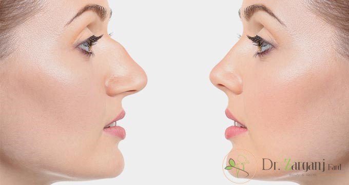چرا از روش غیر جراحی برای اصلاح بینی استفاده می شود ؟