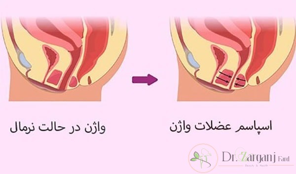 درباره واژینیسموس چه اطلاعاتی دارید؟