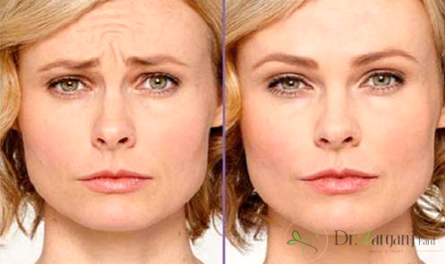 مراقبت های قبل از عمل بوتاکس چیست ؟
