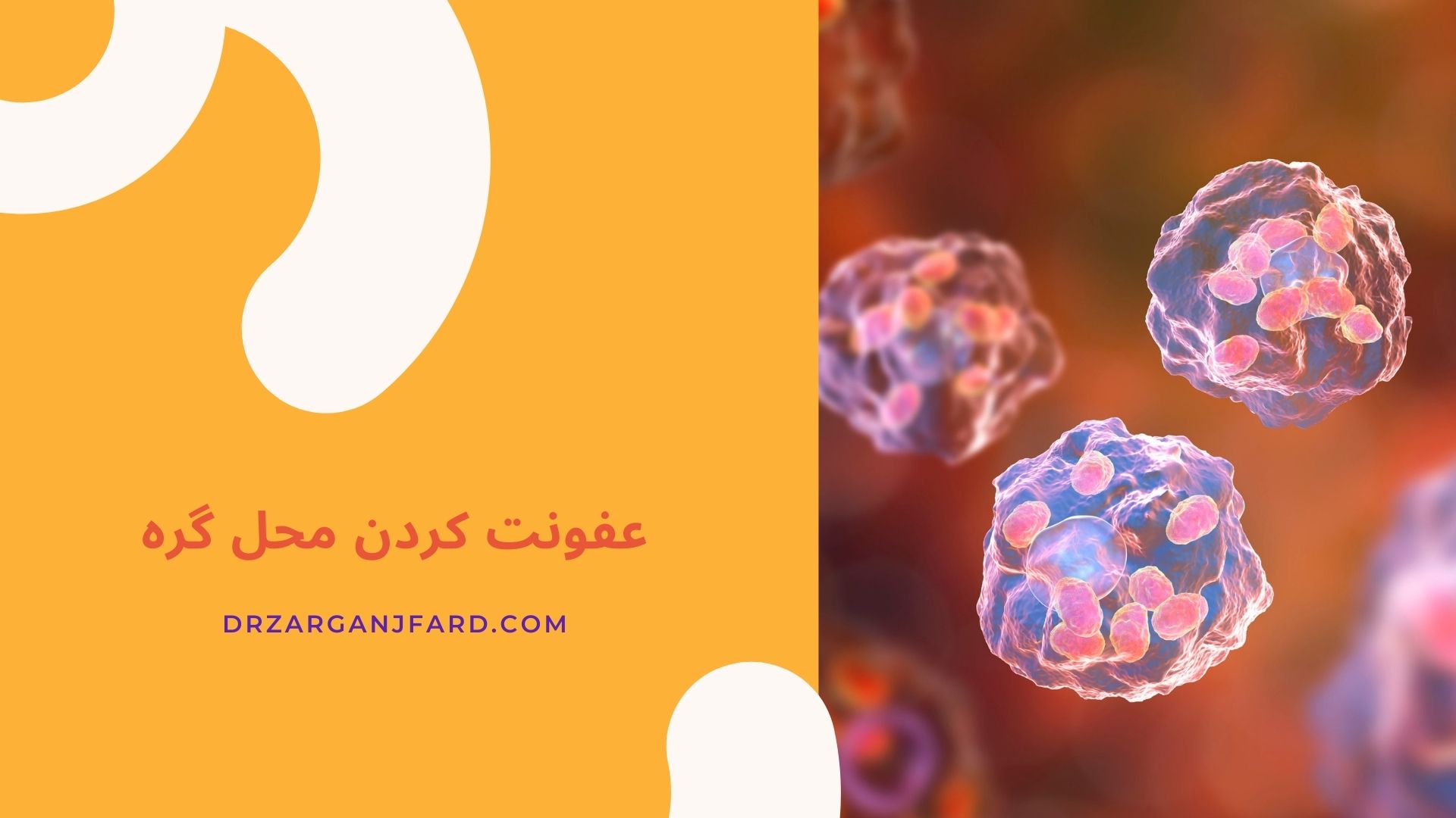 عفونت کردن محل گره