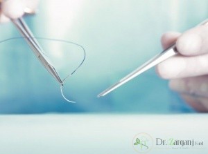 یک عمل بخیه ایده آل چه ویژگی هایی باید داشته باشد؟