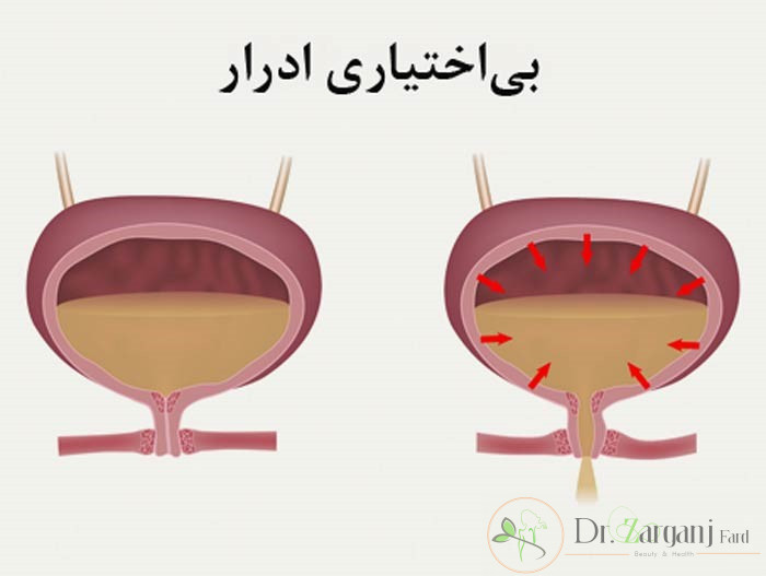بی اختیاری ادرار چیست؟