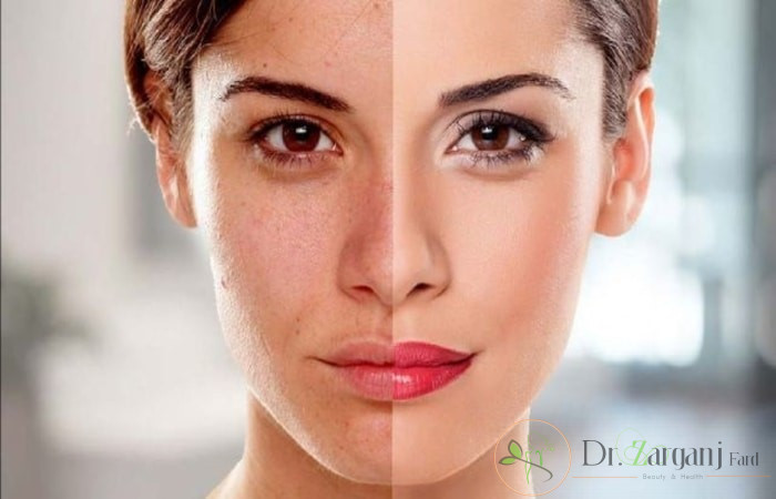 مراقبت های بعد از لیزر سفید کننده پوست به چه صورت است؟