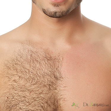 چه افرادی نمی توانند لیزر مو های زائد را انجام بدهند؟