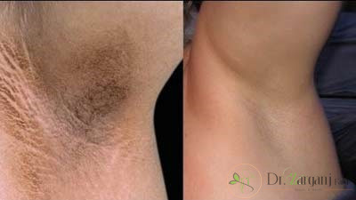 برای پیشگیری از تیرگی زیر بغل چه کارهایی باید انجام دهیم؟