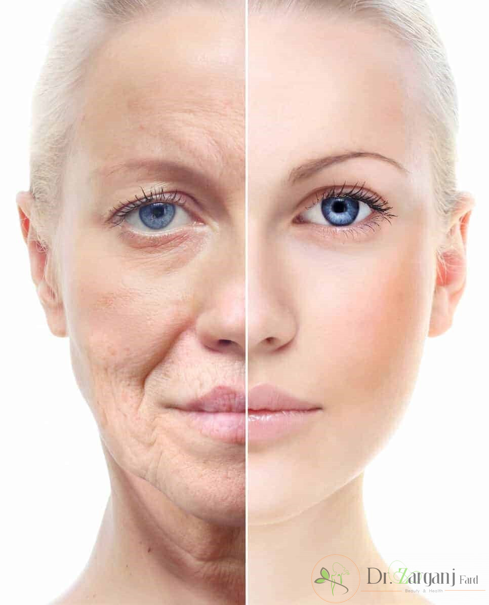 سن تزریق چربی به صورت