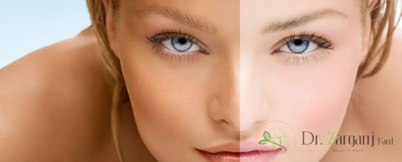 روش لیزر برای برطرف کردن تیرگی پوست یا لکه، دارای چه مزایایی است؟