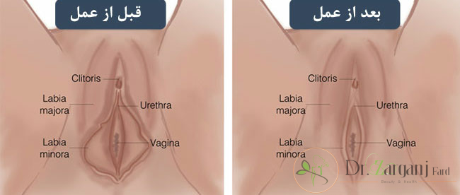 به چه علت هایی زنان تمایل دارند، عمل لابیاپلاستی را انجام دهند؟