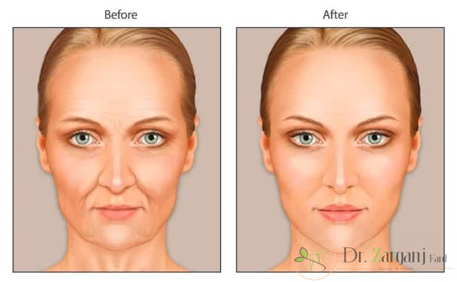 هزینه مرحله دوم تزریق چربی