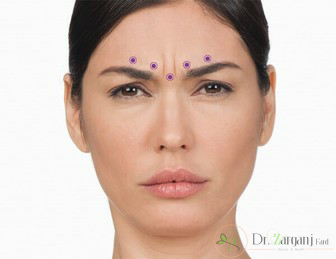 پس از تزریق بوتاکس دیسپورت باید به چه نکاتی دقت کرد؟