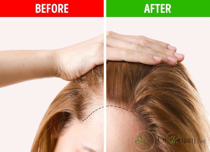 مزونیدلینگ برای چه نواحی از بدن کاربرد دارد ؟