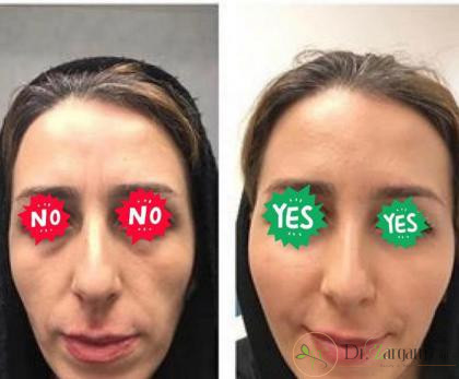 زمان مناسب تزریق چربی برای صورت لاغر چه زمانی است؟