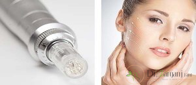 چه افرادی برای انجام مزونیدلینگ مناسب می باشند؟