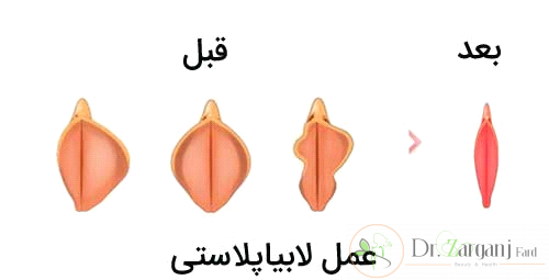 اقدامات قبل از عمل لابیاپلاستی چیست؟