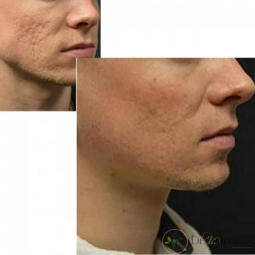 کوکتل های جای جوش و اسکار چه کاربردی دارند ؟