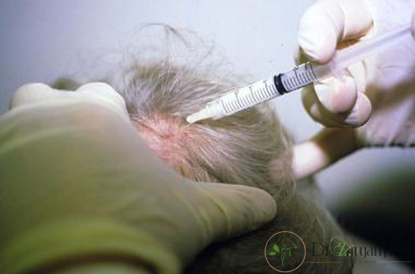 مزونیدلینگ چه تفاوتی با میکرونیدلینگ دارد ؟