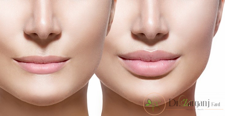 اثر دراز مدت تزریق چربی برای صورت لاغر چگونه است؟