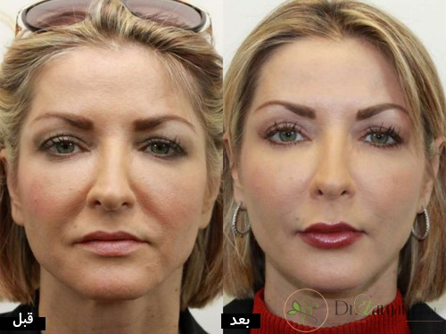بعد از تزریق چربی به صورت باید چه مراقبت هایی انجام داد؟