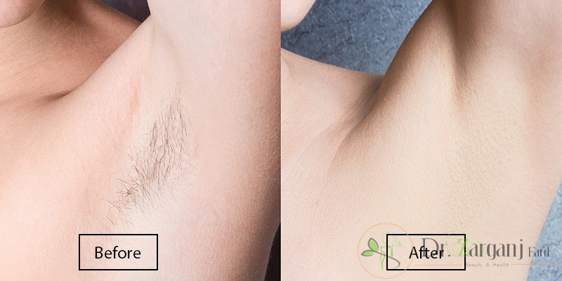 تیغ زدن های زیاد مخصوصا در ناحیه زیر بغل موهای زیر پوستی زیادی ایجاد کرده، آیا لیزر مو کندلا این مشکل را حل می کند؟