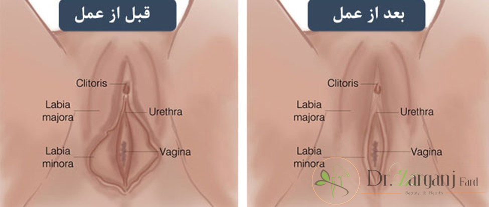 لبیاپلاستی به دو دسته تقسیم می شود که عبارتند از: