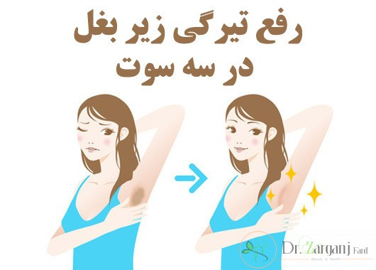 هزینه رفع تیرگی زیر بغل با لیزر