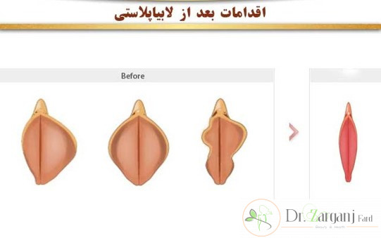 مراقبت های بعد از جراحی لابیاپلاستی به چه صورت می باشد؟