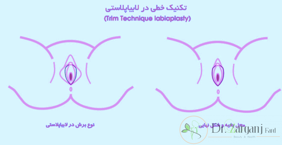 روش اول تکنیک خطی یا Trim Technique Labiaplasty