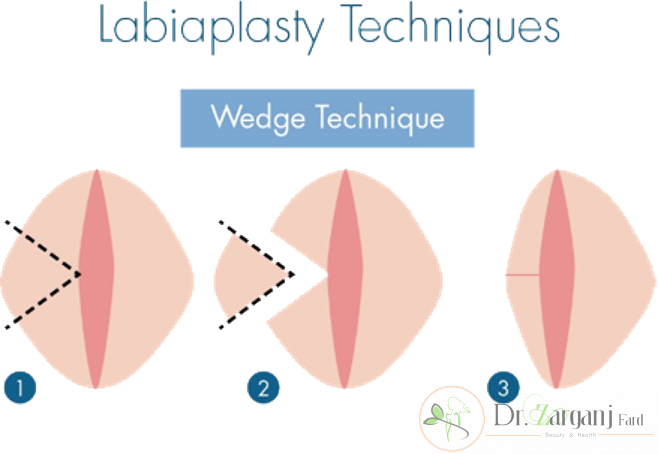 روش دوم تکنیک Wedg Technique