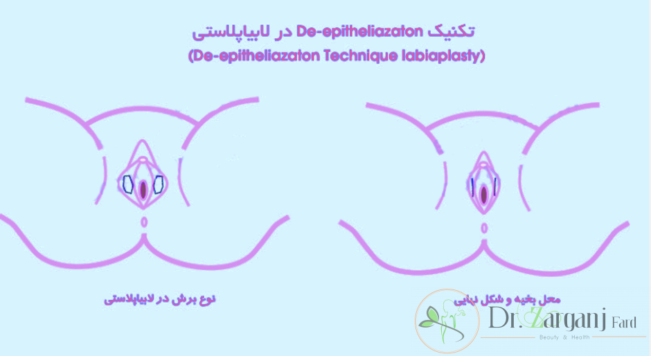 روش سوم تکنیک De- epitheliazaton Technique