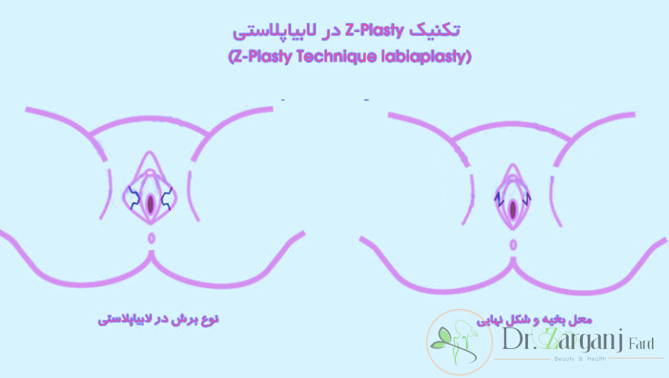 روش پنجم تکنیک Z-Plasty Technique