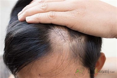 هزینه مزونیدلینگ مو
